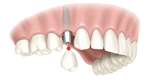 Single Dental Implants West Seneca